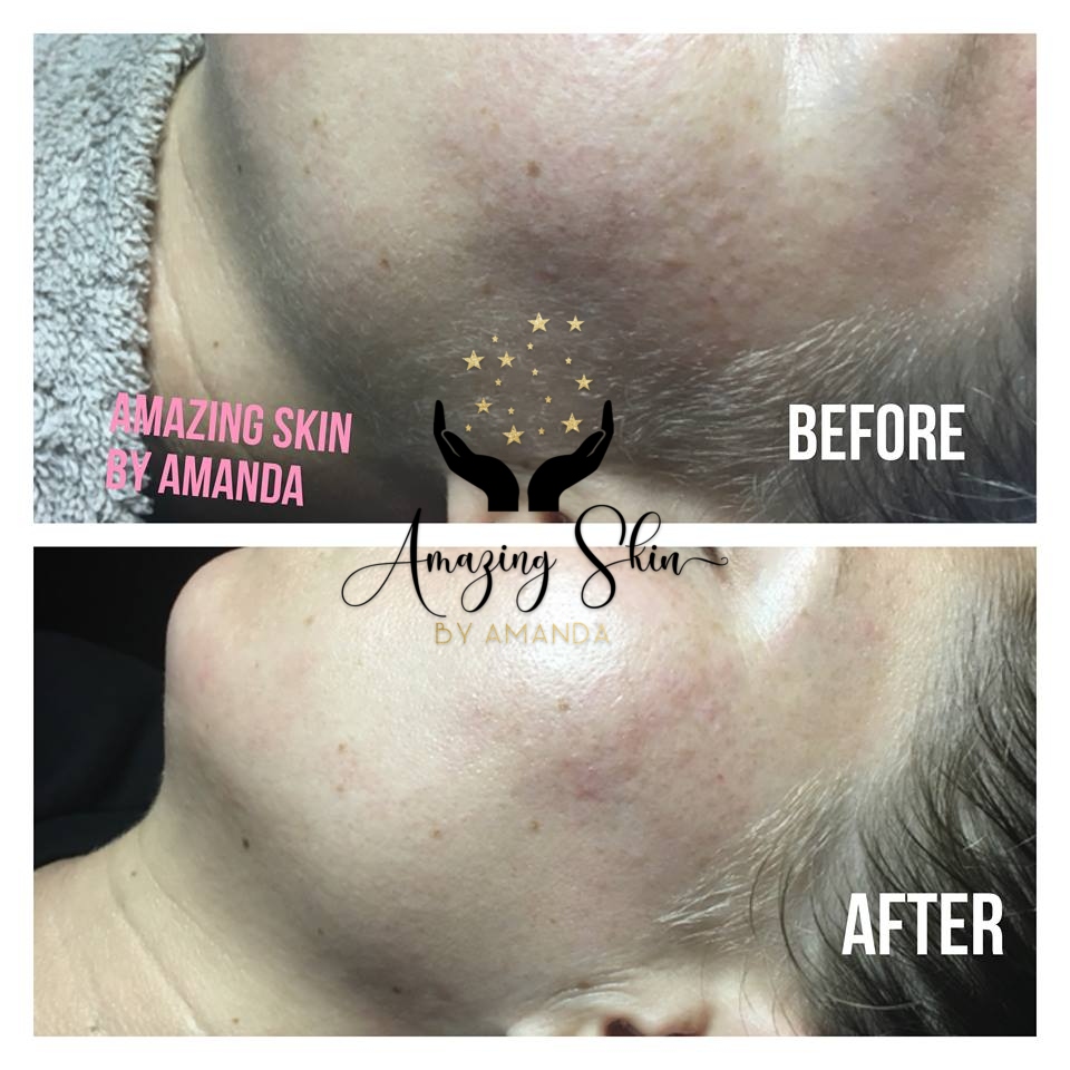  Before and After Dermaplaning Facial